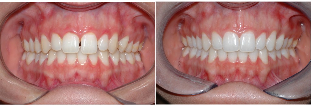 clareamento dos dentes antes e depois